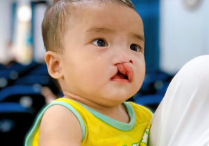 Phẫu thuật nụ cười miễn phí cho trẻ em hở hàm ếch tại Quảng Ngãi