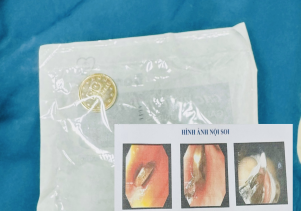 Nội soi gắp dị vật thực quản là đồng xu cho bệnh nhi 5 tuổi