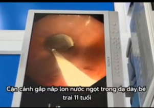 Bệnh viện sản nhi Quảng Ngãi gắp dị vật